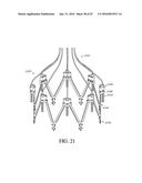 ADJUSTABLE ENDOLUMENAL IMPLANT FOR RESHAPING THE MITRAL VALVE ANNULUS diagram and image