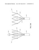 ADJUSTABLE ENDOLUMENAL IMPLANT FOR RESHAPING THE MITRAL VALVE ANNULUS diagram and image