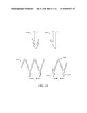 ADJUSTABLE ENDOLUMENAL IMPLANT FOR RESHAPING THE MITRAL VALVE ANNULUS diagram and image