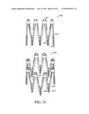 ADJUSTABLE ENDOLUMENAL IMPLANT FOR RESHAPING THE MITRAL VALVE ANNULUS diagram and image