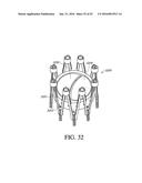 ADJUSTABLE ENDOLUMENAL IMPLANT FOR RESHAPING THE MITRAL VALVE ANNULUS diagram and image