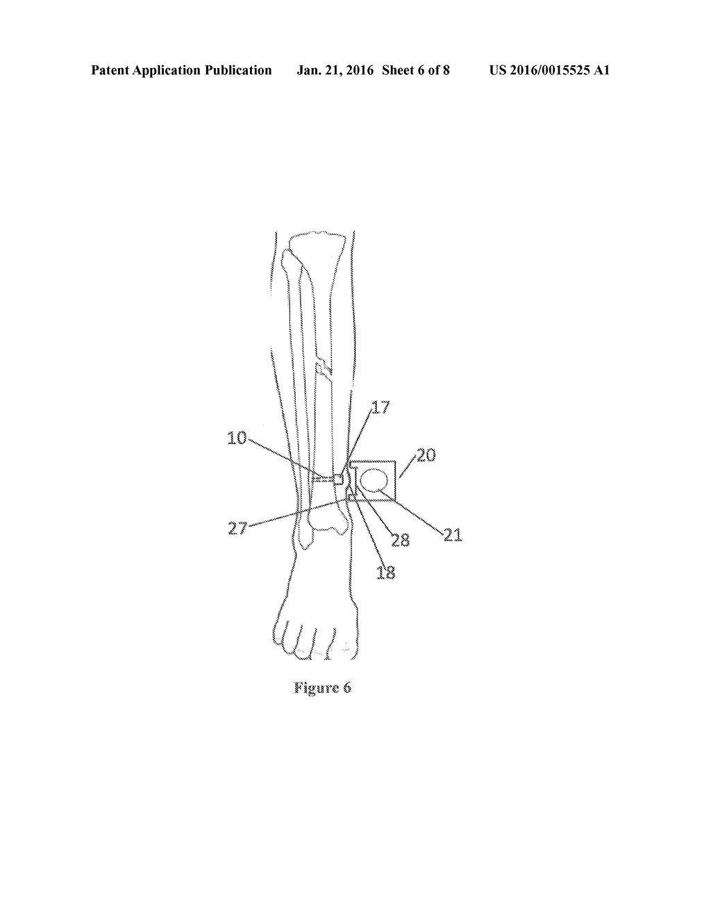 DYNAMIC FORCE GENERATION FOR BONE REPAIR - diagram, schematic, and image 07