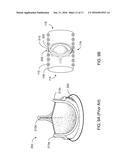 METHODS AND APPARATUSES FOR TREATING VESSELS diagram and image