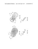 METHODS AND APPARATUSES FOR TREATING VESSELS diagram and image