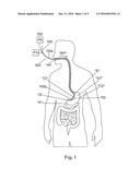 GASTRIC TUBES AND METHODS OF USE diagram and image