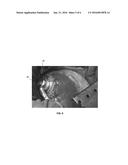 Implantation Of A Transapical Ventricular Assist Device And Kit For Same diagram and image