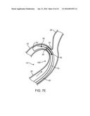 VASCULAR ACCESS SYSTEM AND METHOD OF USE diagram and image