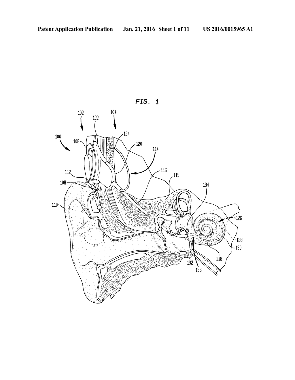 Implantable Stimulating Assembly Arrangements - diagram, schematic, and image 02