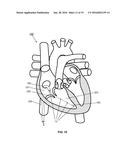 APPARATUS, SYSTEM AND METHODS FOR MEASURING A BLOOD PRESSURE GRADIENT diagram and image