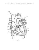 APPARATUS, SYSTEM AND METHODS FOR MEASURING A BLOOD PRESSURE GRADIENT diagram and image