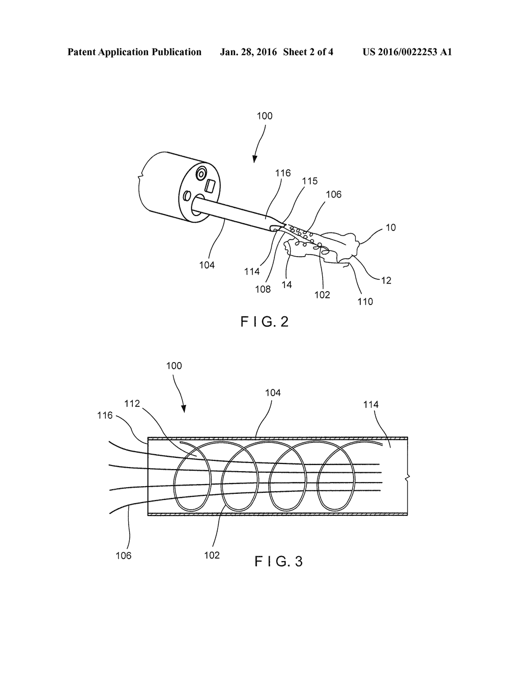 ENDOSCOPIC CLOSURE DEVICE USING SEALANTS - diagram, schematic, and image 03