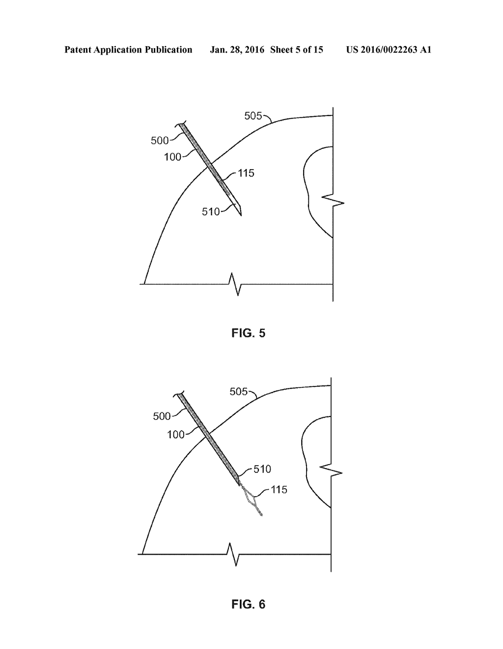 SHAPE MEMORY FILAMENT FOR SUTURE MANAGEMENT - diagram, schematic, and image 06