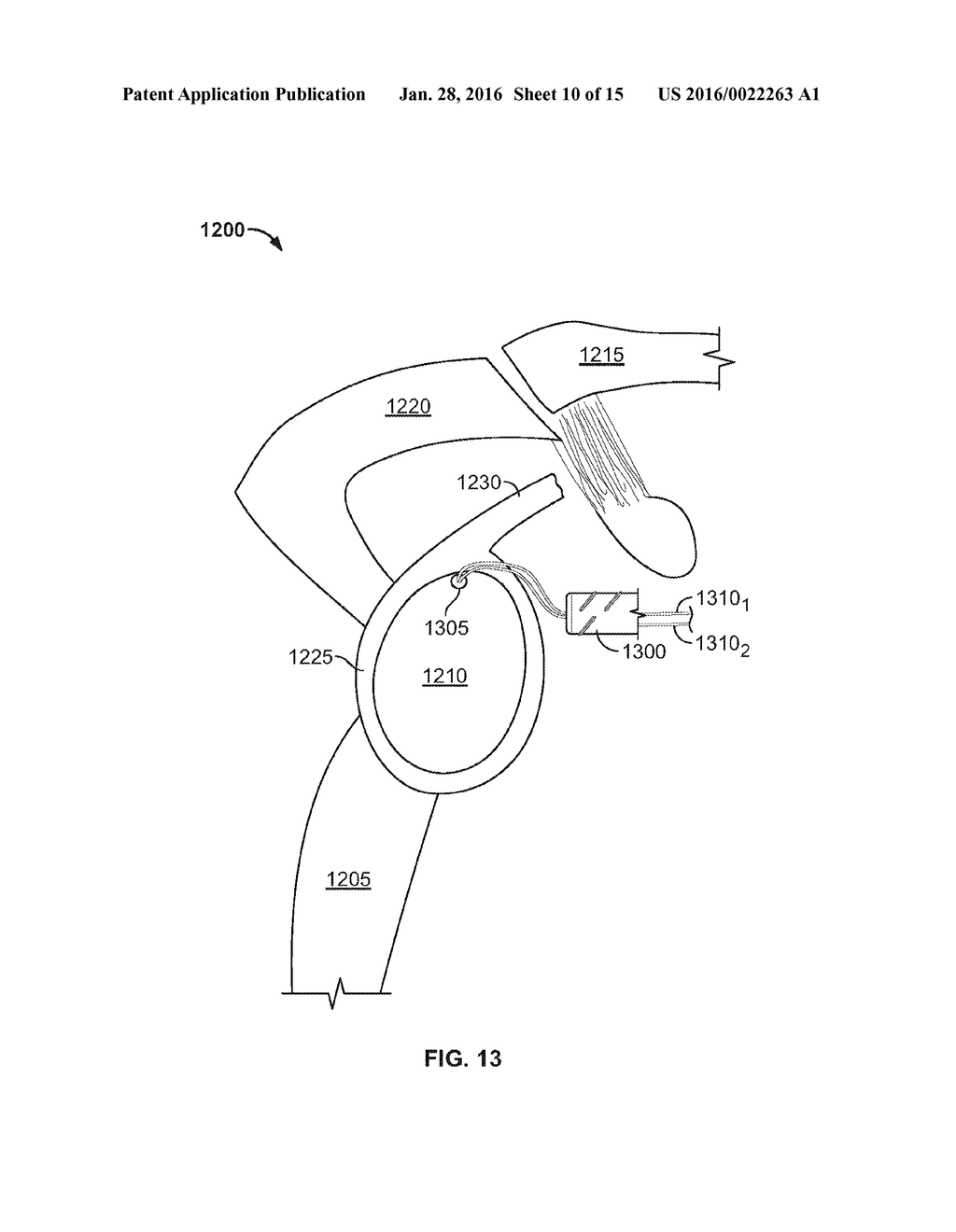 SHAPE MEMORY FILAMENT FOR SUTURE MANAGEMENT - diagram, schematic, and image 11