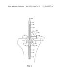 SYSTEMS AND METHODS FOR PROVIDING A BONE MILLING DEVICE diagram and image