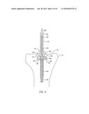 SYSTEMS AND METHODS FOR PROVIDING A BONE MILLING DEVICE diagram and image