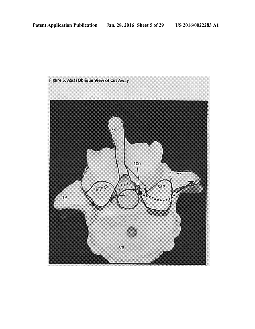 SELECTIVE SPINAL TISSUE REMOVAL APPARATUS AND METHOD - diagram, schematic, and image 06