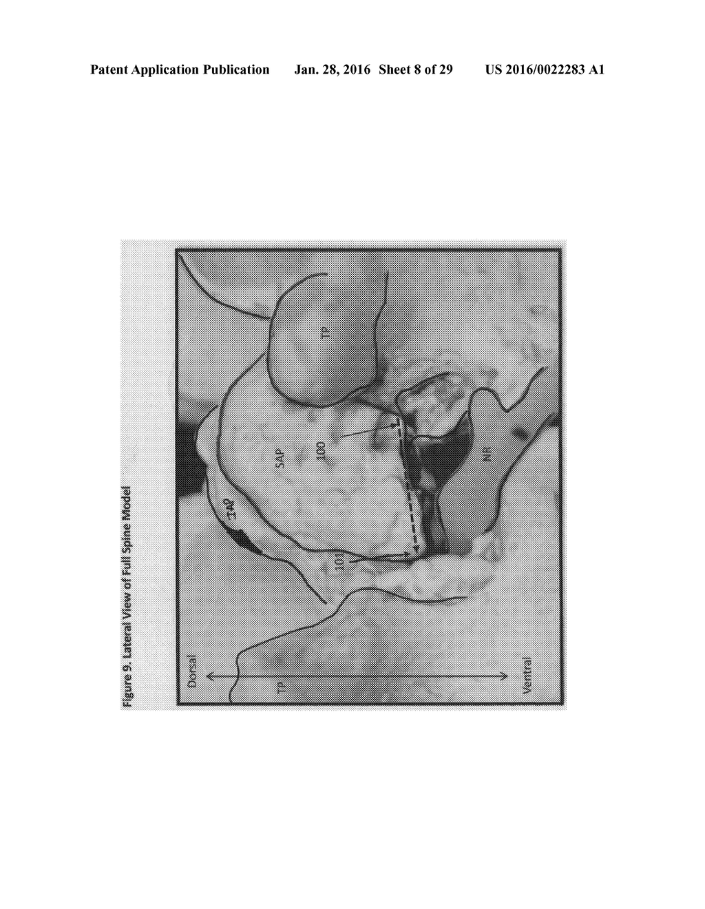 SELECTIVE SPINAL TISSUE REMOVAL APPARATUS AND METHOD - diagram, schematic, and image 09