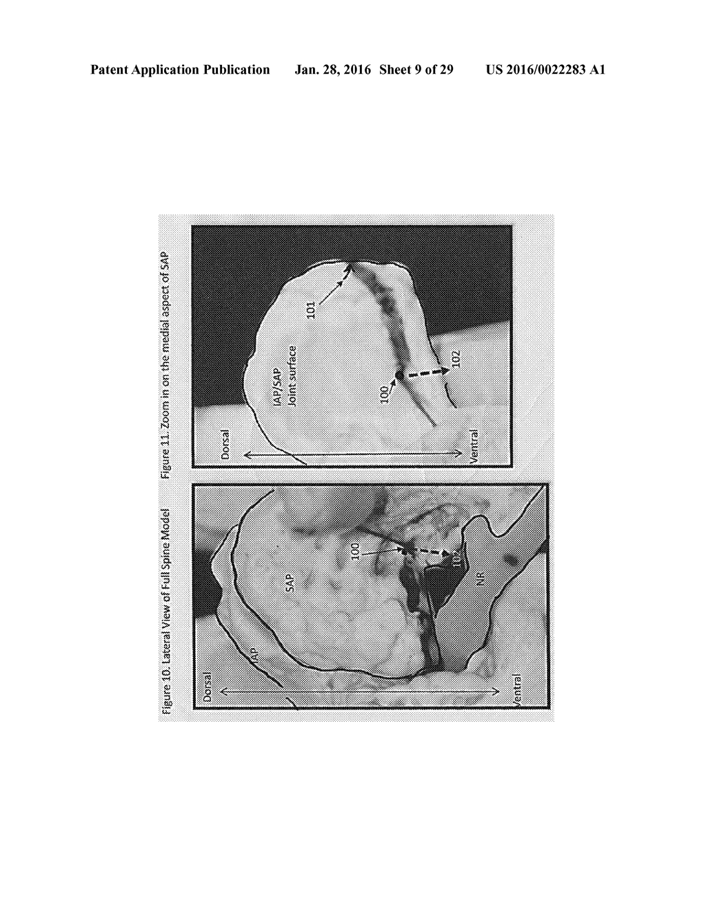 SELECTIVE SPINAL TISSUE REMOVAL APPARATUS AND METHOD - diagram, schematic, and image 10