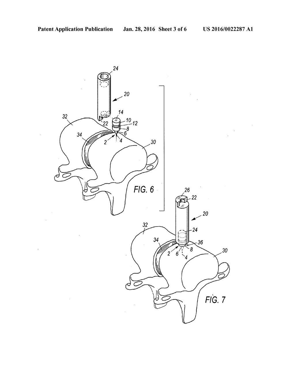 SPINAL MARKER SYSTEM AND METHODS OF USE - diagram, schematic, and image 04