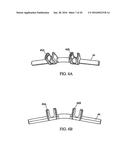 SYSTEM AND METHOD FOR REPLACEMENT OF SPINAL MOTION SEGMENT diagram and image