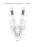 SPINAL ROD SYSTEM AND METHOD diagram and image