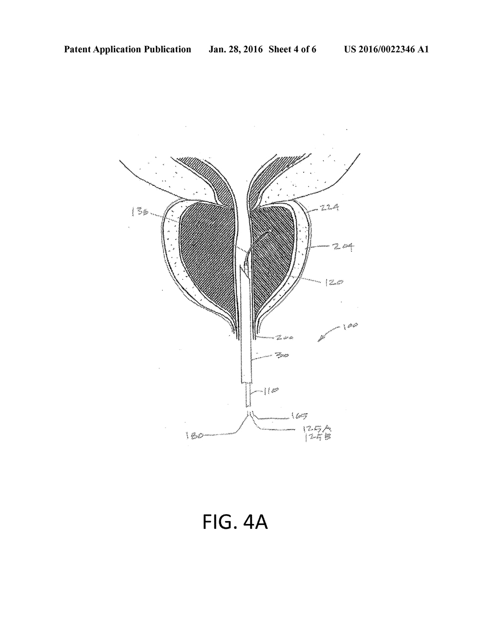 MEDICAL DEVICE AND METHOD OF USE - diagram, schematic, and image 05