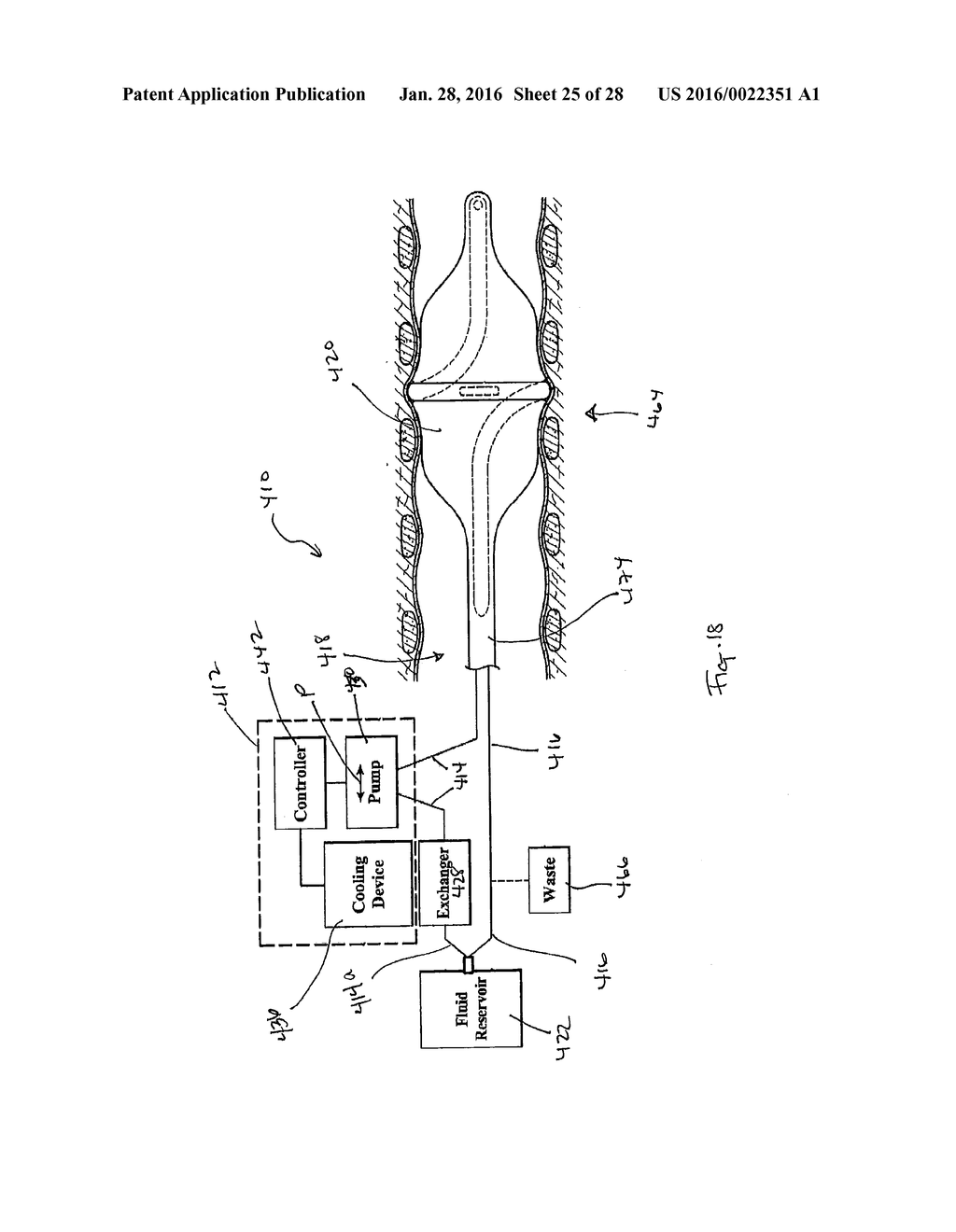 FLUID DELIVERY SYSTEM AND METHOD FOR TREATMENT - diagram, schematic, and image 26