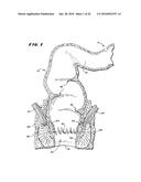 METHOD FOR TREATING FECAL INCONTINENCE diagram and image