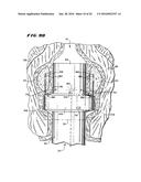 METHOD FOR TREATING FECAL INCONTINENCE diagram and image