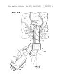 METHOD FOR TREATING FECAL INCONTINENCE diagram and image