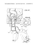 METHOD FOR TREATING FECAL INCONTINENCE diagram and image