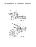 ON-BOARD TOOL TRACKING SYSTEM AND METHODS OF COMPUTER ASSISTED SURGERY diagram and image