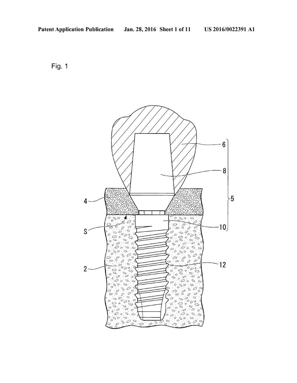 PROSTHESIS - diagram, schematic, and image 02