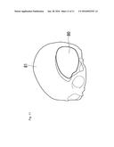 PROSTHESIS diagram and image