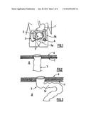 IMPLANT FOR PARASTOMAL HERNIA diagram and image