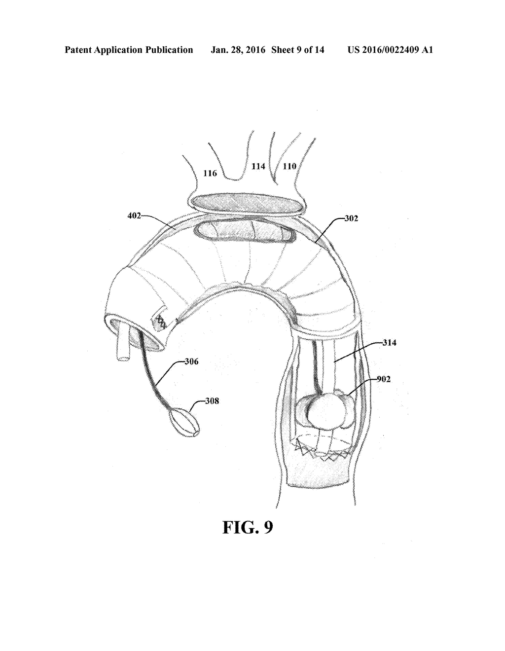 ENDOVASCULAR PERFUSION STENT GRAFT - diagram, schematic, and image 10