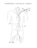 ENDOLUMINAL PROSTHESIS HAVING MULTIPLE BRANCHES OR FENESTRATIONS AND     METHODS OF DEPLOYMENT diagram and image