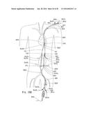 ENDOLUMINAL PROSTHESIS HAVING MULTIPLE BRANCHES OR FENESTRATIONS AND     METHODS OF DEPLOYMENT diagram and image