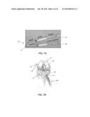 APPARATUS AND METHOD FOR LIGAMENT RECONSTRUCTION diagram and image