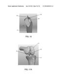 APPARATUS AND METHOD FOR LIGAMENT RECONSTRUCTION diagram and image