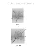 APPARATUS AND METHOD FOR LIGAMENT RECONSTRUCTION diagram and image