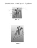 APPARATUS AND METHOD FOR LIGAMENT RECONSTRUCTION diagram and image