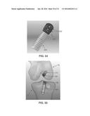 APPARATUS AND METHOD FOR LIGAMENT RECONSTRUCTION diagram and image