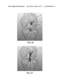 APPARATUS AND METHOD FOR LIGAMENT RECONSTRUCTION diagram and image