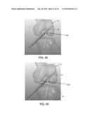 APPARATUS AND METHOD FOR LIGAMENT RECONSTRUCTION diagram and image