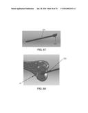 APPARATUS AND METHOD FOR LIGAMENT RECONSTRUCTION diagram and image