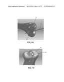 APPARATUS AND METHOD FOR LIGAMENT RECONSTRUCTION diagram and image