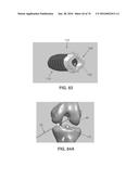 APPARATUS AND METHOD FOR LIGAMENT RECONSTRUCTION diagram and image