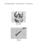 APPARATUS AND METHOD FOR LIGAMENT RECONSTRUCTION diagram and image