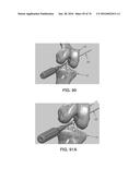 APPARATUS AND METHOD FOR LIGAMENT RECONSTRUCTION diagram and image